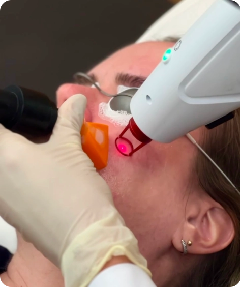 Laser para vasos da face - Dra Tatiana Losada